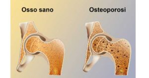 osteoporosi-calcio-vitamina D-Studio di Nutrizione-Patrizia Di Mare